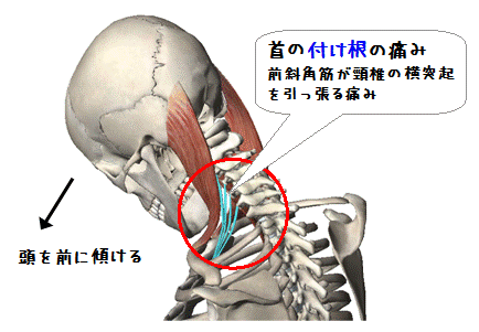 首の付け根の痛み（図解）